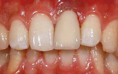 八月份病历展示：种植科前牙种植修复