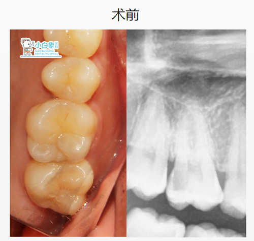 10月补牙病例1