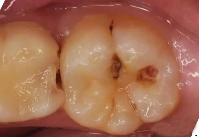 步步惊心的牙齿版