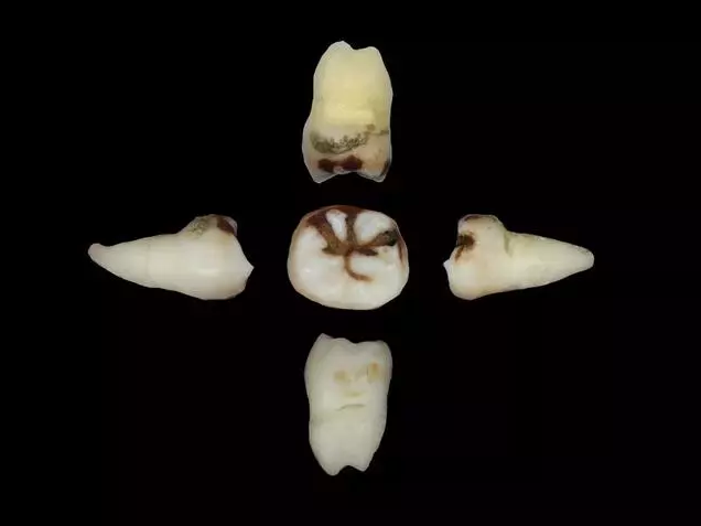 牙结石长什么样?